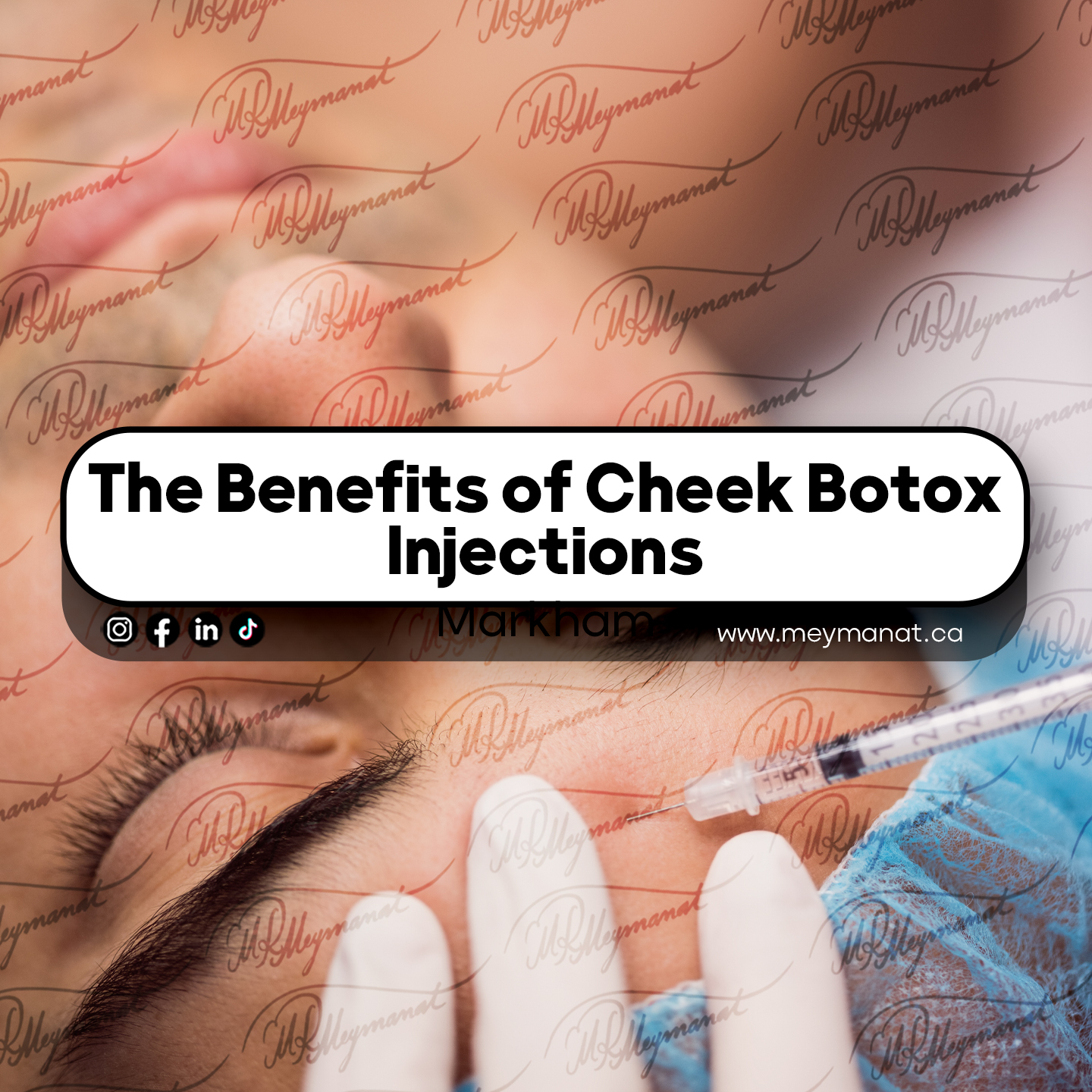 The Benefits of Cheek Botox Injections